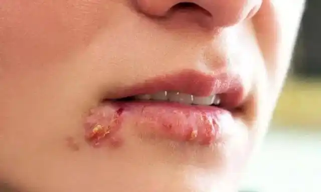 嘴角老是长"水泡",原来是这个病!