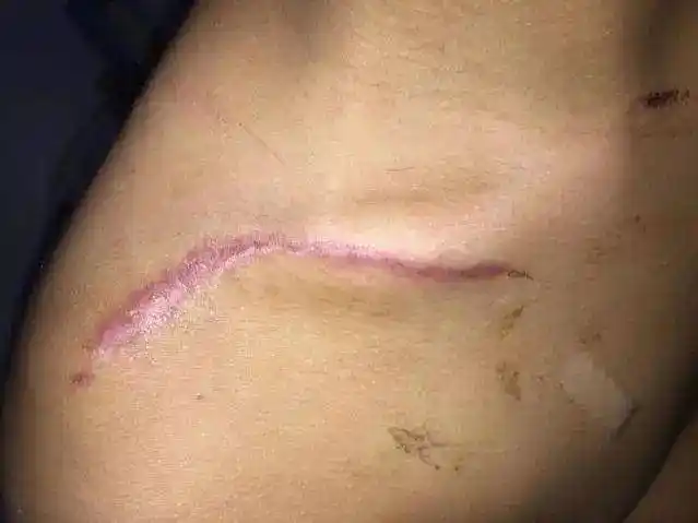 孩子骨折手术会不会留下一个大疤?医生:这样就不会