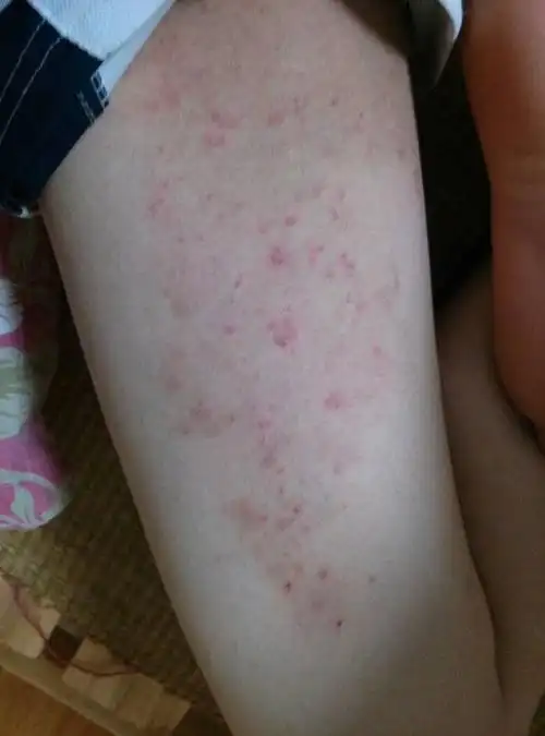 这是什么皮肤病