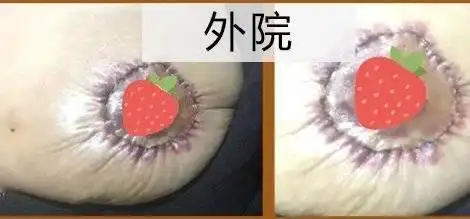 双环法:在乳晕周围做两个切口,此术式对乳房的提升和塑形效果并不明显