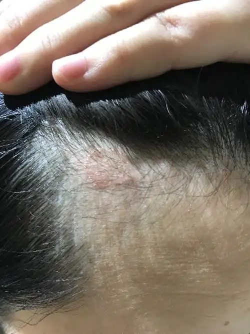 今天头皮这里有点痒,照镜子一看有一圈红色,这是什么情况?