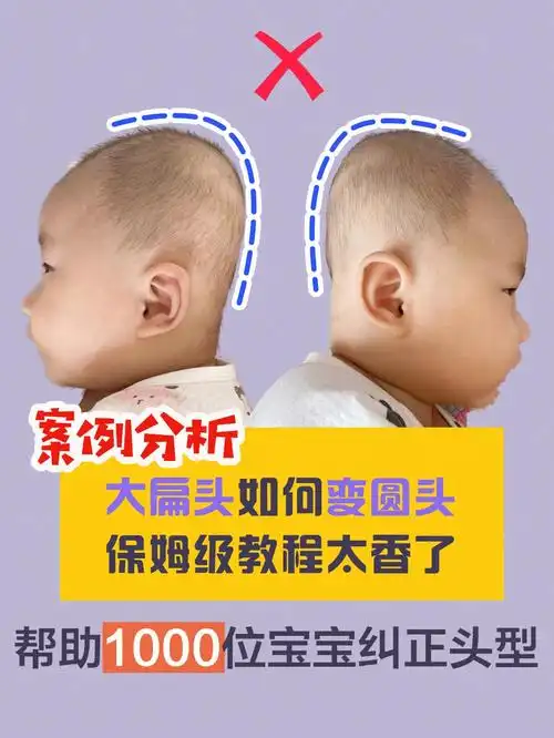 睡圆头手把手教你睡圆头扁头逆袭教程