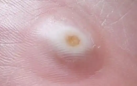 脚上长鸡眼怎么办脚鸡眼图片大盘点图