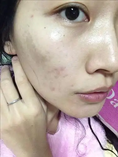 手贱去扣痘痘,呜呜,这样的痘印多久能消