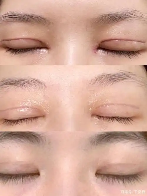 本来就想今年夏天割的,考虑的当时的天气,很适合去做双眼皮,可能恢复