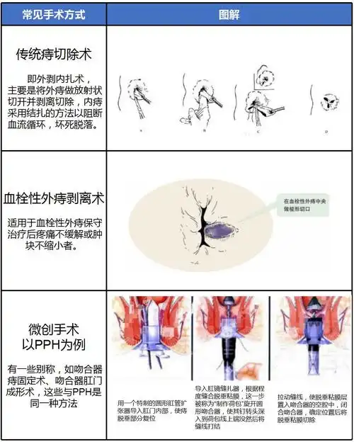痔疮有微创手术么