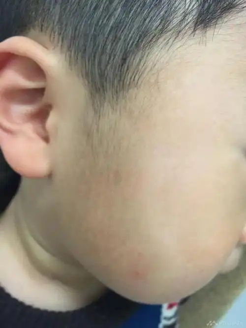 面部无色素痣一例