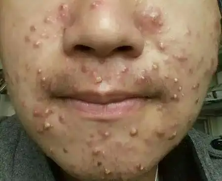 长满了痘痘的脸这简直活脱脱就是一颗荔枝