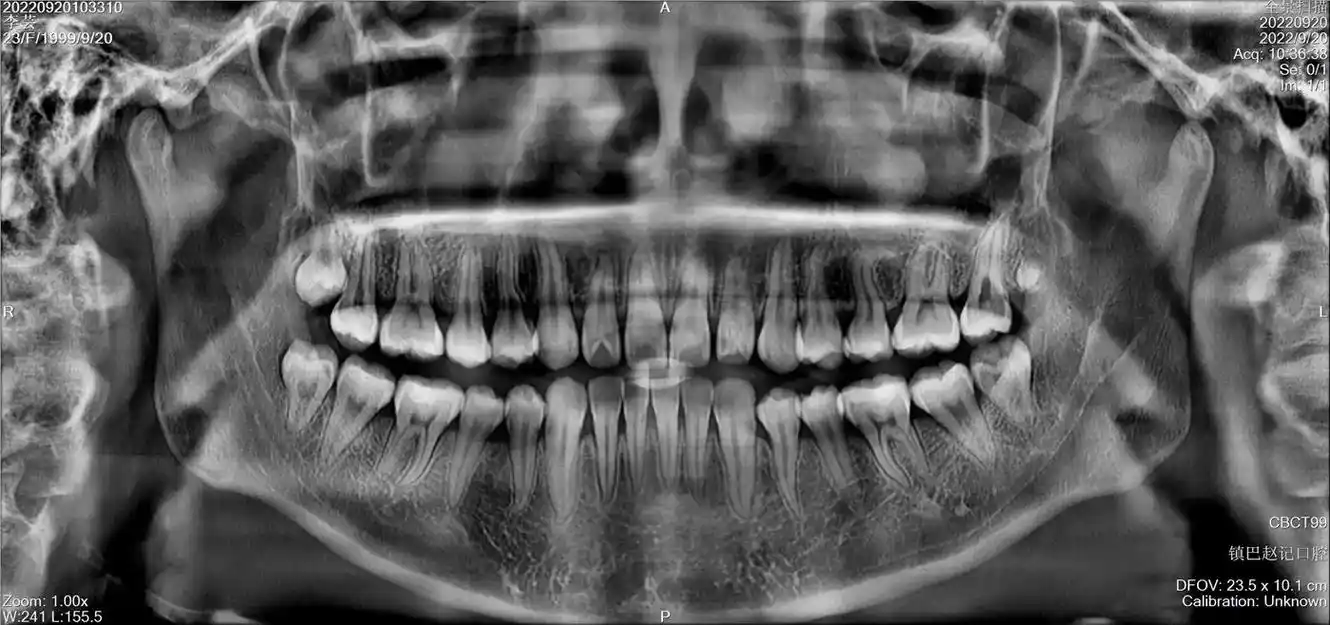 牙齿写真集#牙医日常 #口腔ct图片 - 抖音