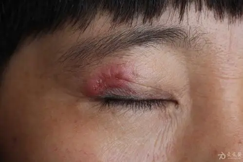 临床第三区 69 皮肤及性传播疾病讨论版 69 典型病例——眼睑