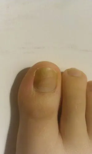 大拇指脚趾甲左前部分好像中空了,这是怎么了.