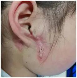 第1鳃裂瘘管反复感染引起的瘢痕组织第3鳃裂瘘管引起的颈部感染因瘘管