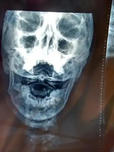 请问这个颈椎错位是第几节?