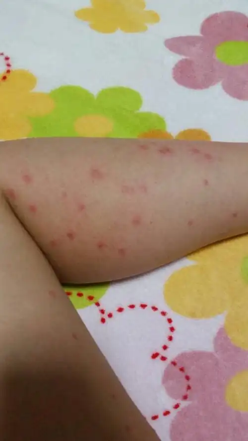 腿上长红点,不到一下午越长越大,很痒,是怎么回事