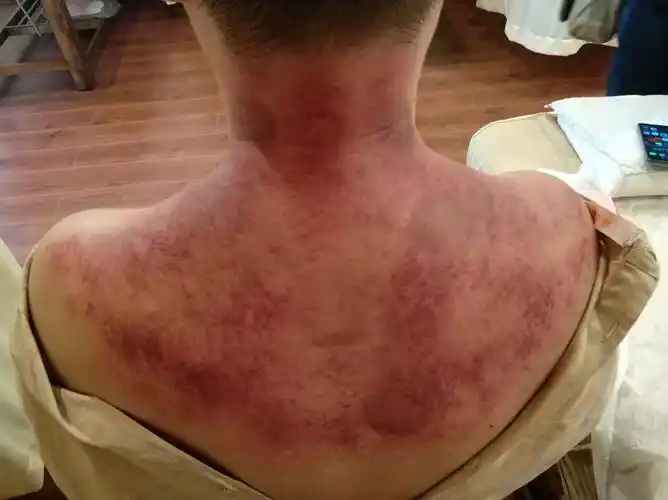 下面是我给他刮痧的出痧图根据他的情况,建议他行砭石的刮痧,然后在