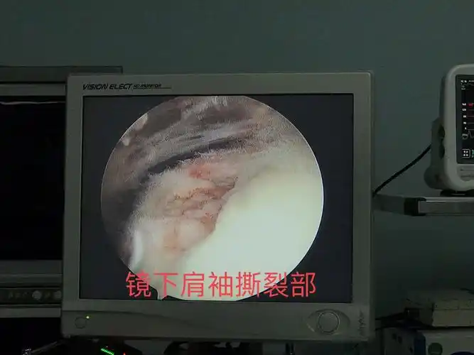 菏泽市立医院关节外科 肩关节镜 肩袖损伤