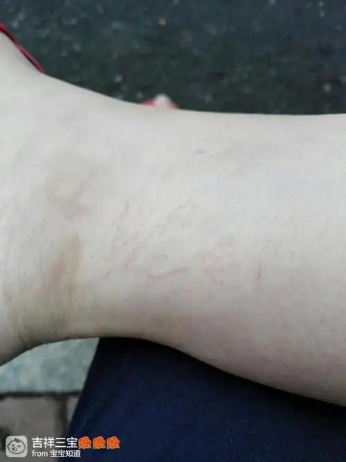 脚踝长了很多血丝