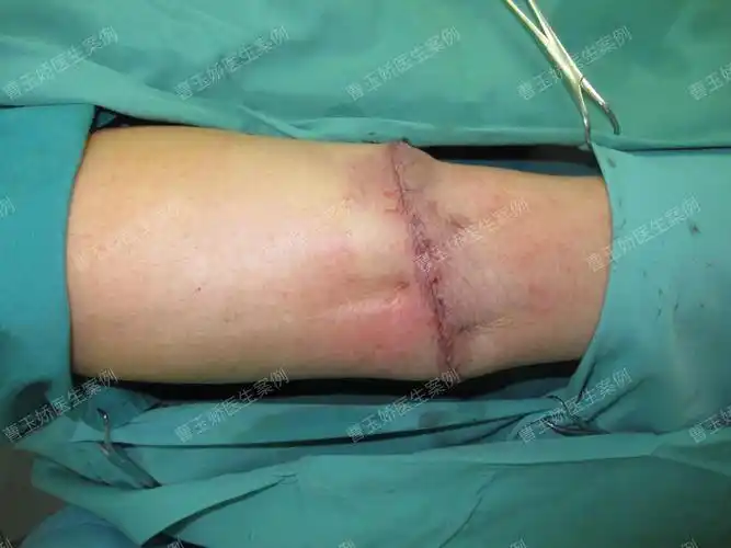 扩张器治疗黑痣案例分享_痣_痣治疗方式 - 好大夫在线