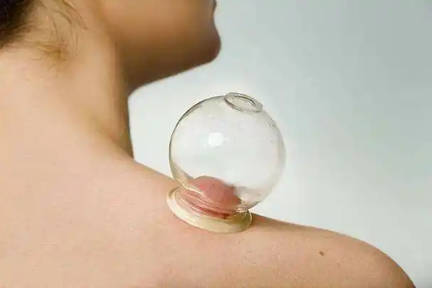 拔火罐吸出来的瘀血,是体内的毒素吗?告诉你真相,看完涨知识了