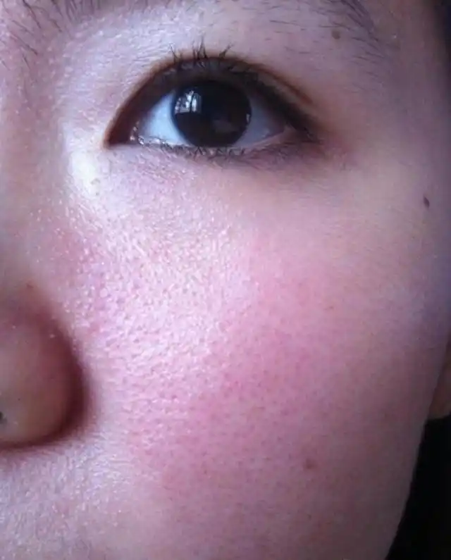 皮肤毛孔粗大就是缺水?是你的皮肤营养不够了,赶快内调 外养吧