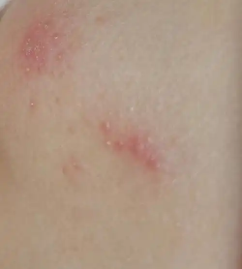 想问问大佬们胸部有红疹是怎么回事?