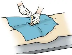 尿道擦洗选择生理盐水还是碘伏有什么区别