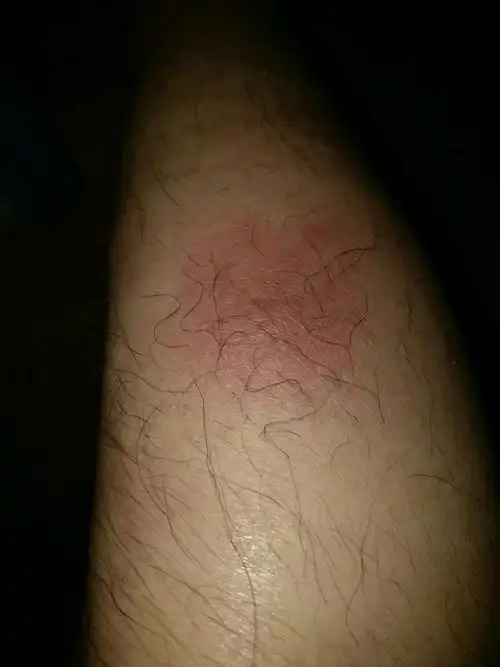 小腿从三月29号晚开始出现红肿,30号早上扩大并变硬,触痛按压痛,怀疑