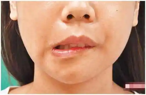 医生告诫:脑溢血和脑血栓病发前各有4个前兆,积极预防可保命!