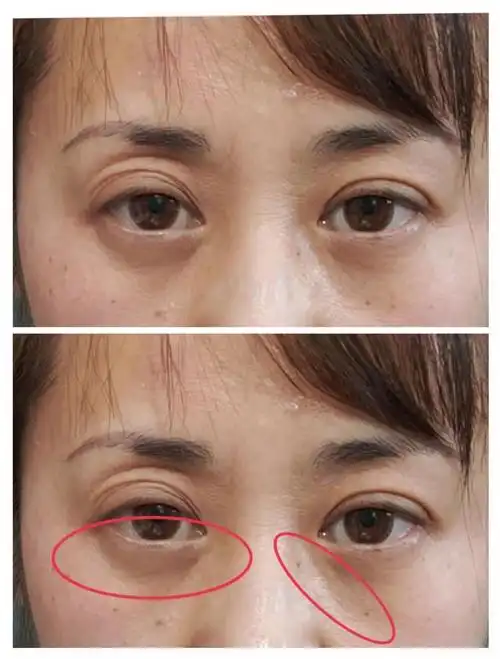 西安健丽机构去眼袋手术效果差造成严重凹陷