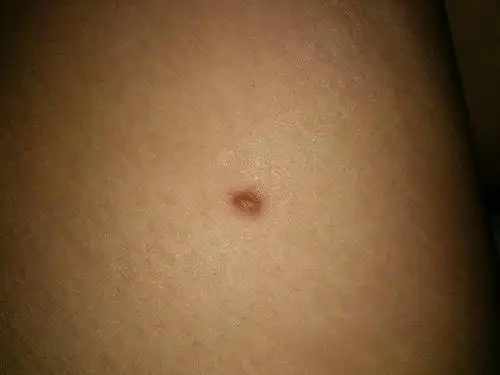 请问这是黑色素痣吗?不痛不痒.急