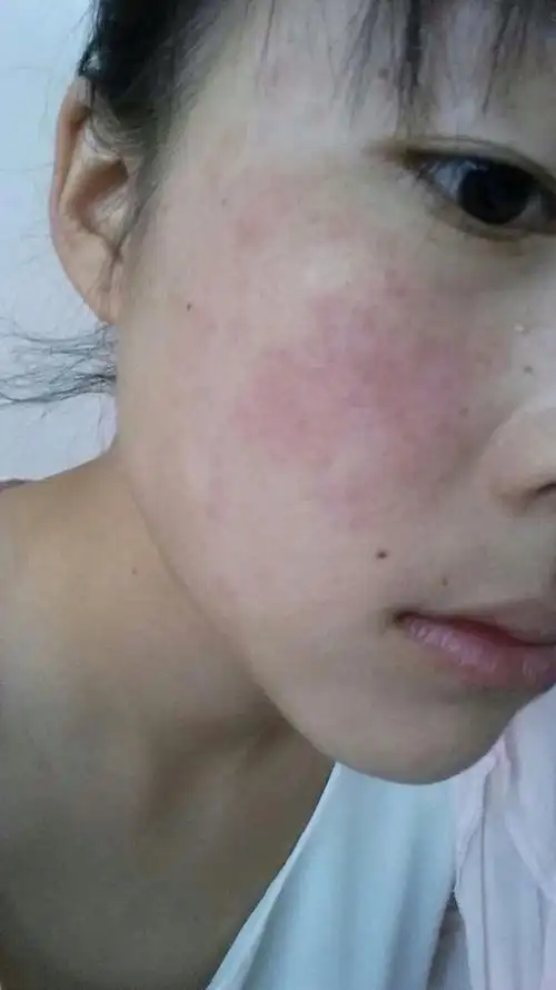 脸上红了一片,不痒不疼,跟过敏似的,怎么办?