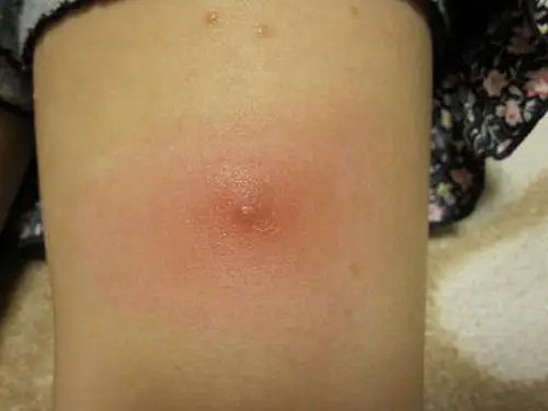 皮肤囊肿图片 (30)_有来医生