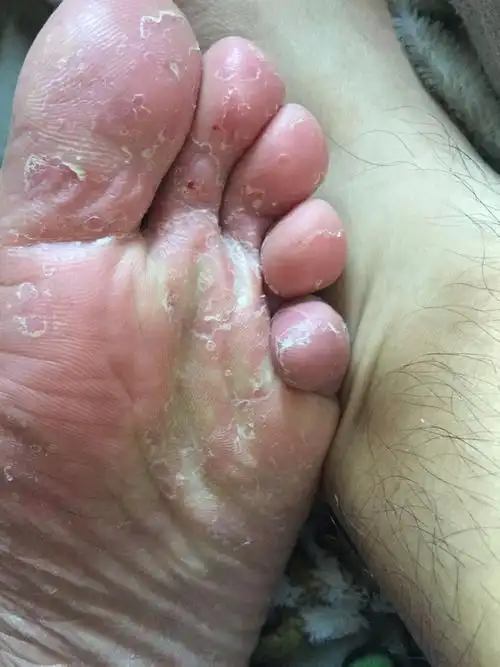 请问我脚是怎么回事?掉皮 开口 痒 但是脚不臭.
