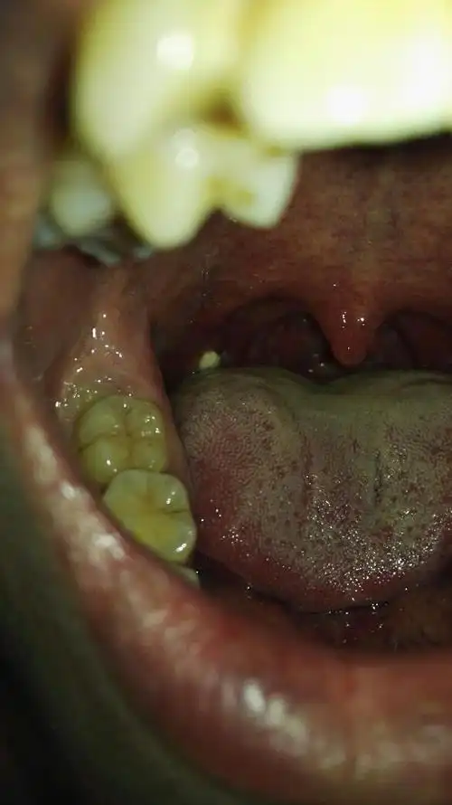 如图,口腔内壁长了一个白色的疙瘩,不痛不痒,就有一点异物感,请问是