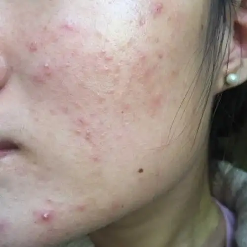 一周前长了好多这种分不清到底是闭合性粉刺还是脓包型痘痘还是丘疹型