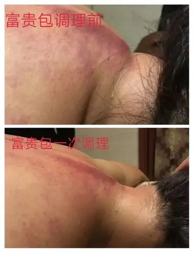 告诉你!肩颈淤堵有多可怕! - 美篇