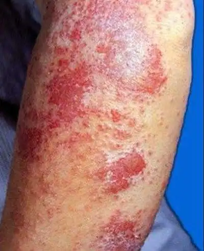 男梅毒初期图片40