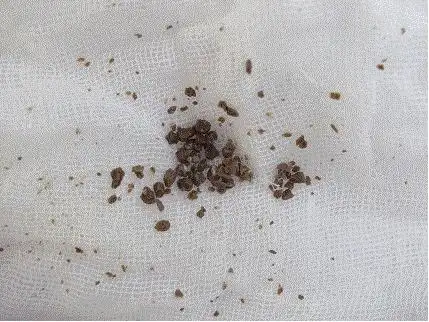 肾结石患者不要吃草酸丰富的食物,吃这些才排石