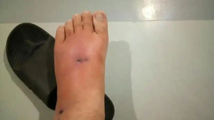 脚背於肿,感觉好严重,会有什么大问题吗?