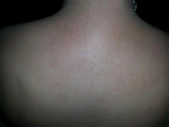 后背长鸡皮疙瘩似的一大块,不痛不痒而且会慢慢扩大!