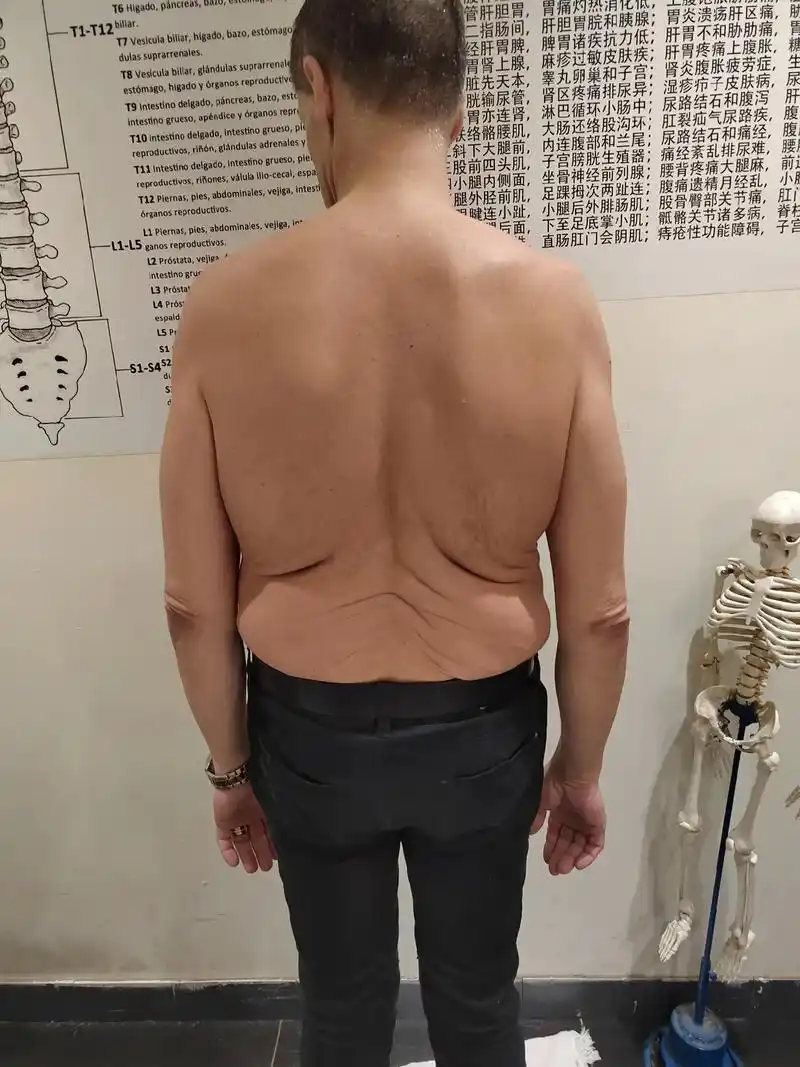 因为过度肥胖导致l3-4,l4-5,l5-s1椎体压缩性退化 - 抖音