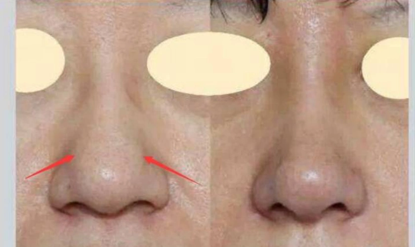 为了让大家更清晰的了解到鼻翼软骨的位置,我们来看一个案例吧.