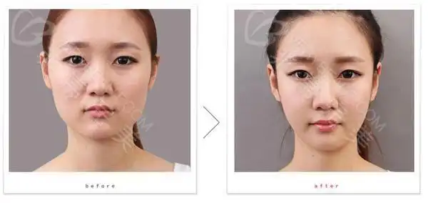 垫下巴前后对比