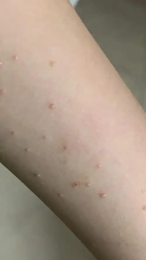 水瘊子需要治疗吗