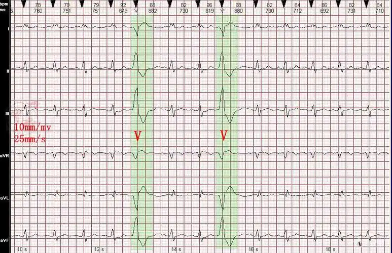 心电图病例分析完全性左束支阻滞室性早搏1