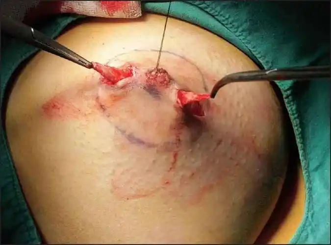 乳头内陷怎么办图片_有来医生