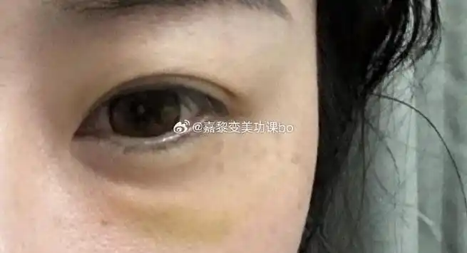 记录一次的弗曼泪沟填充失败