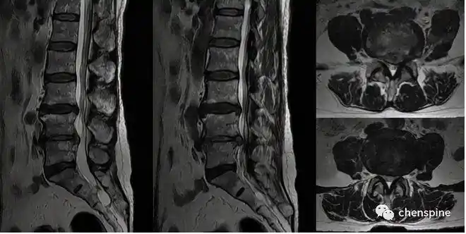 腰椎管狭窄常见问题解答