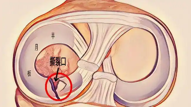 "响":半月板损伤时,膝关节会有弹响的声音,就好像摁圆珠笔,自动铅笔的