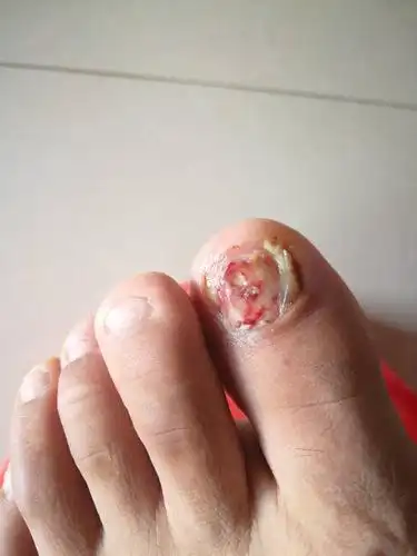 脚趾甲这样掉了用啥好的快